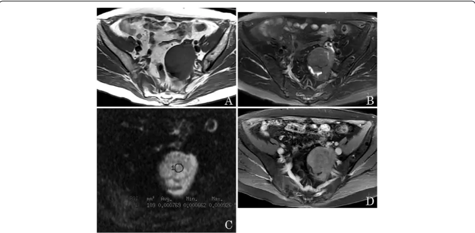 Figure 5 Comparative diagnostic values of quantitative apparent diffusion coefficient (ADC) value parameters for discriminatingbetween benign and malignant ovarian tumors