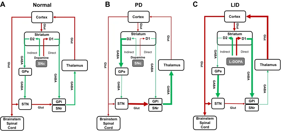 Figure 1 Classic basal ganglia model representing (A) normal condition, (B) Parkinson’s disease, and (C) Parkinson’s disease with LiD.Notes: Normally dopaminergic input from SNc facilitates motor movement through excitatory response on direct pathways via 