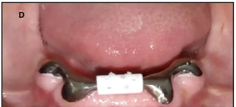 Figure 1. Pre-operative intraoral view showing positions of  remaining teeth in mandibular arch after intentional root canal treatment 