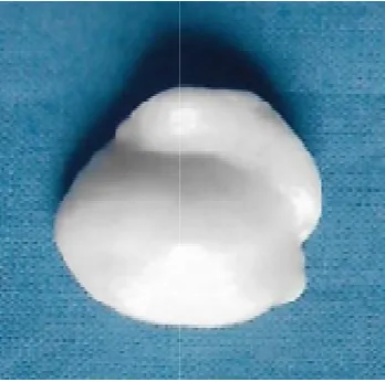 Figure 2. Impression of enucleated socket with light body silicone impression material with the help of disposable syringe and Impression of enucleated socket with light body silicone impression material with the help of disposable syringe and custom made acrylic tray   