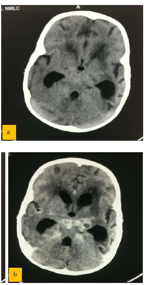 Figure 1. NCCT(a) AND CECT(b) head in a 4 year old child with decreased mAs protocol in a patient of meningitis showing acceptable image quality at reduced radiation dose protocol  