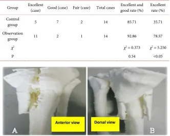 Table 2. Comparison of functional recovery of knee joint between group A and group B after operation for complex tibial plateau fractures