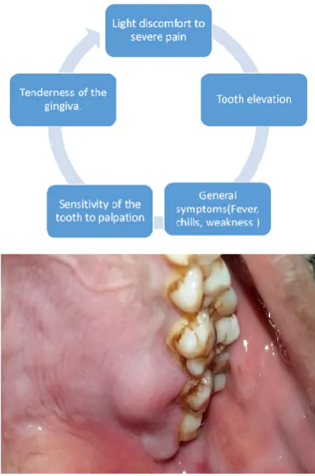Fig. 3. Gingival abscess associated with maxillary premolar and first molar 