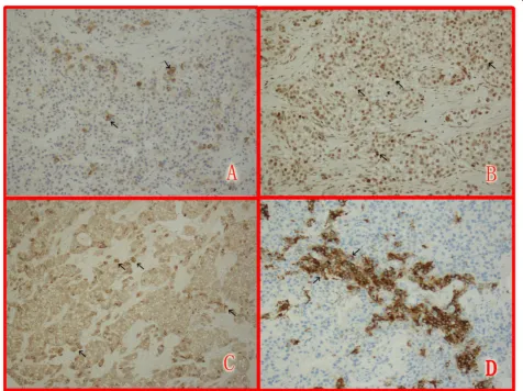Figure 3 Immunohistochemical staining of AFP, p53, CK7 andparaffin-embedded and sectioned for histological analysis