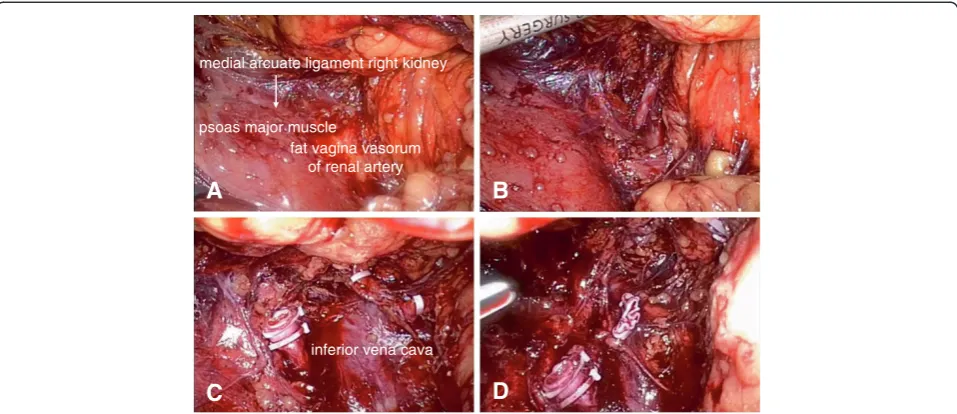 Figure 1 Demonstration of modified technique. (A) A demi-mounded apophysis at the renal pedicle near the psoas major muscle; thisapophysis is the fat vagina vasorum of the renal artery
