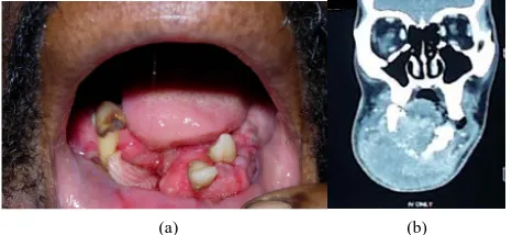 Figure 7. Early squamous cell carcinoma. Innocuous-looking lesion. 