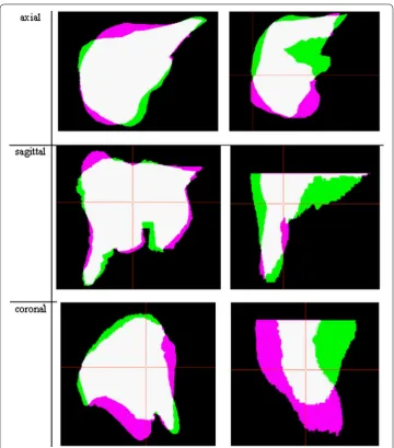 Fig. 5 Drawings of registered liver surfaces in projections: axial (left) and coronal (right) using the Rigid registration method for training data set