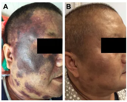 Figure 2 Change in skin lesions.Notes: (A) Large skin lesions on the face before therapy