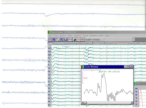 Figure 170 years of progress in clinical EEG analysis: from visual analysis of EEG traces on paper (background picture) to visual analysis of EEG traces displayed on CRT (front)