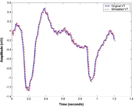 Figure 7A patient ECG and simulated ECG with VT