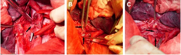 Figure 1 A 51-year-old female with esophagotracheal fistula for 7 months underwent division of the fistulous tract and closure of the trachea and esophagus.Notes: (A) The tissue flap (arrow) is toward the trachea and before repair the entire opening of the