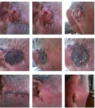 Figure 1. An extensive protruding (4 cm × 4 cm × 2 cm) BCC with central ulceration and raised curly borders on the right side of his face next to his ear is seen in patient 1 (top row)