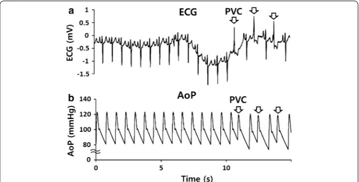 Fig. 3 (PVC) obtained from a congestive heart failure patient, and a Representative electrocardiogram (ECG) data showing temporary premature ventricle contraction b the patient’s AoP, reproduced by the Windkessel model
