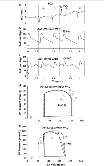 Fig. 5 Representative curves for dbeat was normal (immedicately decreased (a patient ECGs, b AoP without VAD perfusion, c AoP with VAD perfusion,   pressure–volume (PV) curves of LV without VAD, and e PV curves of LV with VAD