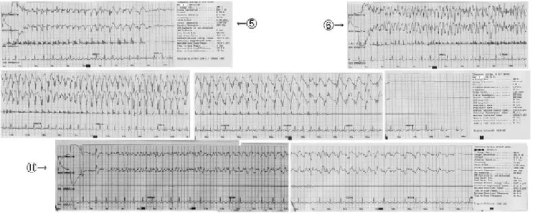Figure 2: EEG and EMG charts of the 5 th , 6 th and 11 th trials.