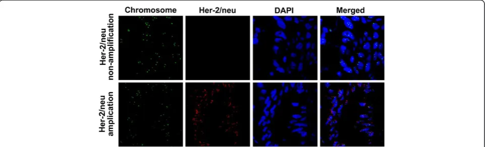 Figure 2 Fluorescence in situ hybridization of HER-2/neu amplification (original magnification, ×60).