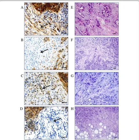 Fig. 1 Representative examples of immunohistochemical expression of TAZ and YAP in TNBC patients.and in non-lymphocytic stromal cells.non-lymphocytic stromal cells