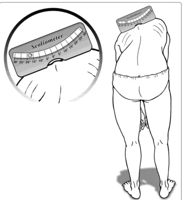 Fig. 1 The inclination is measured by placing the scoliometer on the back hump according to Adam’s forward bending test