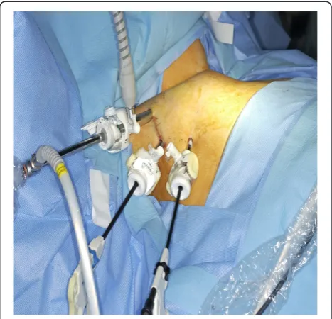 Figure 1 Operative view of ipsilateral axillary approachendoscopic thyroidectomy. Two trocars (5mm and 10mm) areinserted through axillary incisions
