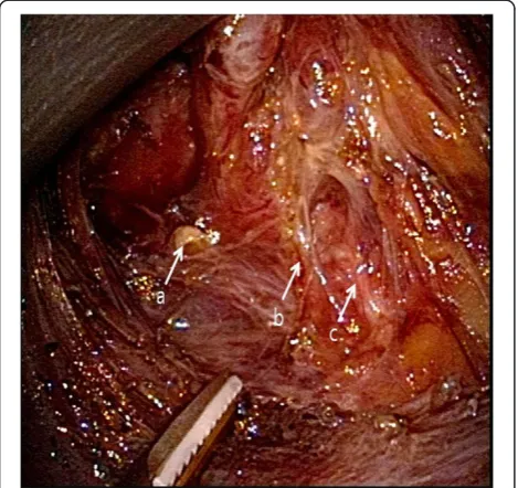Figure 2 Lateral view of the operative field during thecoperation. The recurrent laryngeal nerve was separated carefullyfrom the thyroid gland, and the inferior thyroid artery, whichcrossed the recurrent laryngeal nerve,was divided with a harmonicscalpel