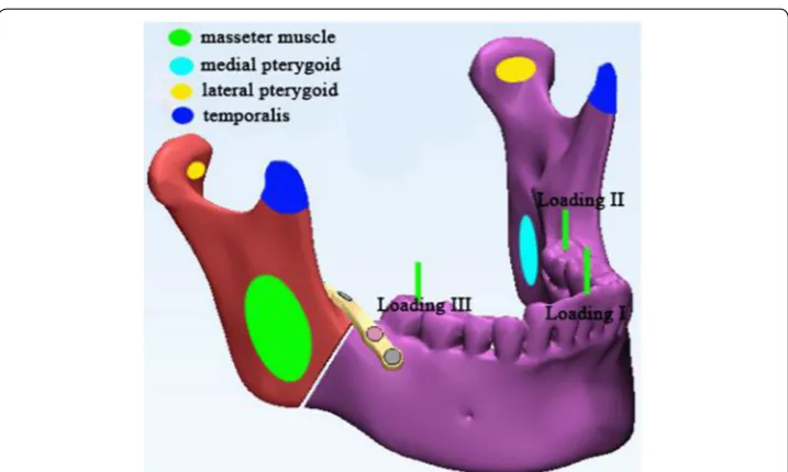 Fig. 4 Loading and muscle areas on the mandible. Four kinds of mandible muscles were modeled as springs at the colored ovals, and the three green lines represented the three occlusal situations: loading I, incisor loading with 125 N, loading II, left second molar loading with 250 N, and loading III, right second molar load‑ing with 250 N