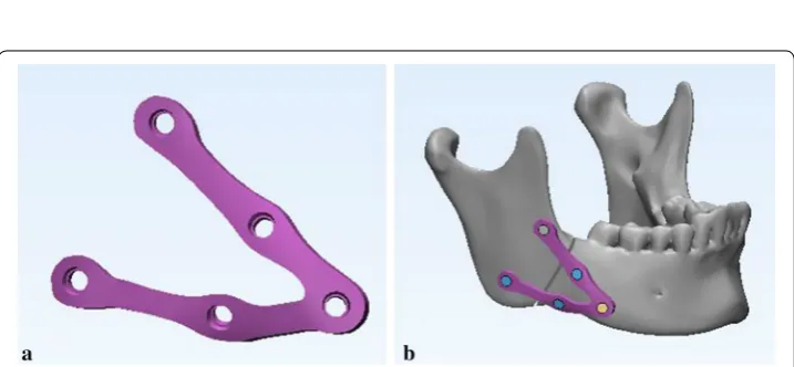 Fig. 10 Fractured mandible with customized fixation system. a Final customized plate, and b customized fixation system (plate and screws) fixed on the fractured mandible