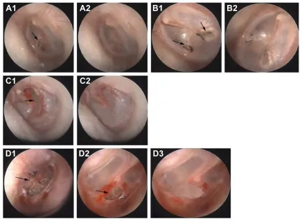 Figure 1 The typical cases of all kinds of membrane perforation.Notes: a representative case of tympanic membrane perforation (A1) before treatment of small perforation; (A2) after treatment of small perforation; (B1) before treatment of small perforation in control group; (B2) self-healing of small perforation in control group; (C1) before treatment of middle perforation; (C2) full healing treatment for two times with sea buckthorn oil; (D1) before treatment of large perforation; (D2) after treatment for three times with sea buckthorn oil; and (D3) full healing after treatment for five times with sea buckthorn oil.
