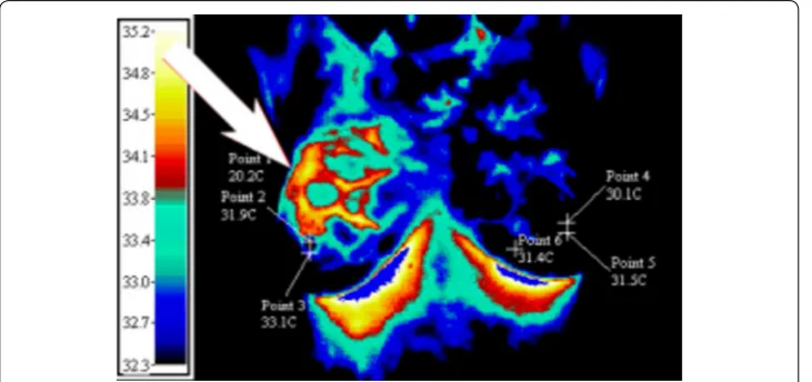 Fig. 13 Thermal image of breast with an abnormal mass in the right breast