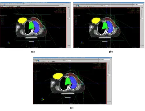 Figure 1. IMRT DVHs for breast cancer patient number one using (a) CON; (b) SUP; (c) FSUP algorithmsIMRT DVHs for breast cancer patient number one using (a) CON; (b) SUP; (c) FSUP algorithmsIMRT DVHs for breast cancer patient number one using (a) CON; (b) SUP; (c) FSUP algorithms    