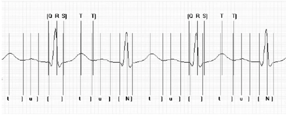 Figure 5Insertion of beat markers with a correlation interval of (a) 560 ms (b) 280 msInsertion of beat markers with a correlation interval of (a) 560 ms (b) 280 ms