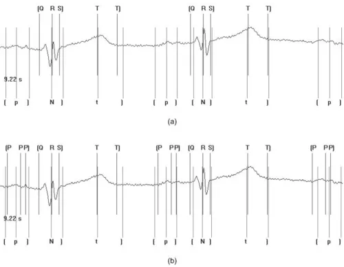 Figure 6Insertion of beat markers for threshold values of (a) 85% (b) 60% of training averagesInsertion of beat markers for threshold values of (a) 85% (b) 60% of training averages