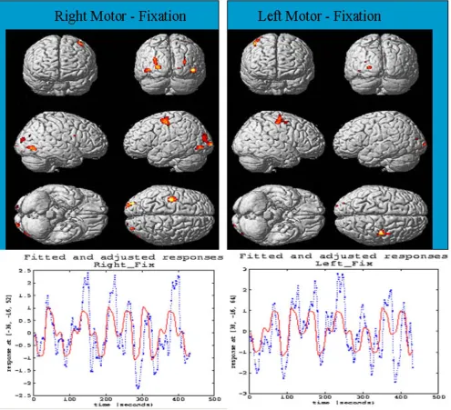 Figure 10Selected brain regions showing the activation areas observed by fMRI during finger movementthan threshold of 3.5 are displayed in red color