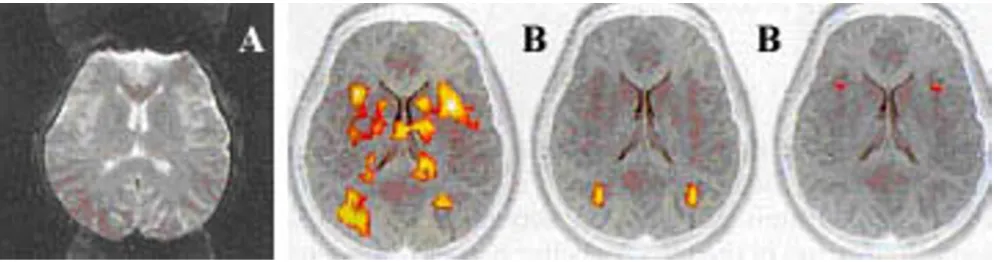 Figure 3the figure represents Nyquist ghost in panel A and representative fictitious activation in panel Bthe figure represents Nyquist ghost in panel A and representative fictitious activation in panel B