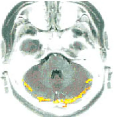 Figure 5An example of an fMRI image of the normal brain is shownAn example of an fMRI image of the normal brain is shown