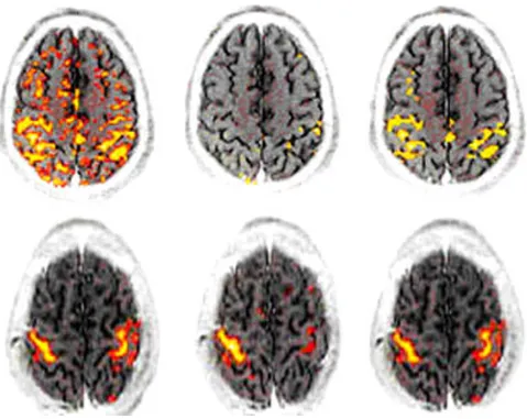 Figure 6The figure illustrates the effects of motion correction algorithm SPM 96The figure illustrates the effects of motion correction algorithm SPM 96