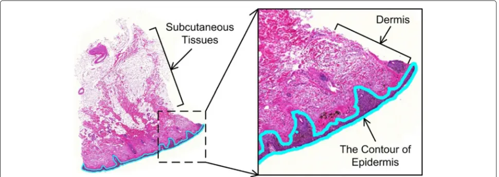 Fig. 1 Example of skin tissue digital slide (superficial spreading melanoma). Note that the manually labeled contour of the epidermis area issuperimposed on the WSI