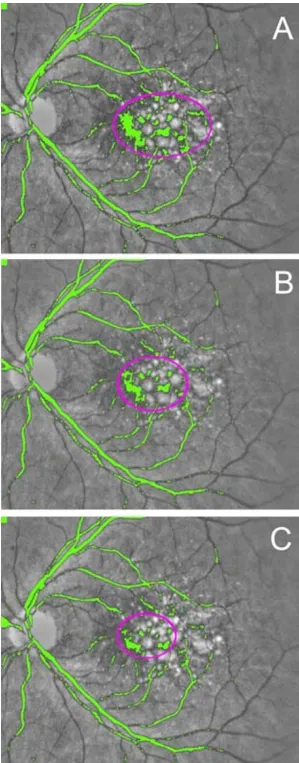 Figure 1Iterative macular background leveling. Processing takes place in the green channel; gray scale is used here for better reproduction