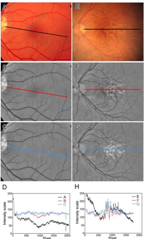 Figure 2Line scans demonstrating macular background leveling for drusen recognition. Left Panel