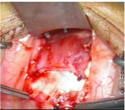 Figure 1. Faden suturing. 