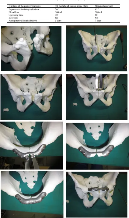 Table 1. Differences between 3D model and custom made plate and standard approach to diastasis of pubic symphysis