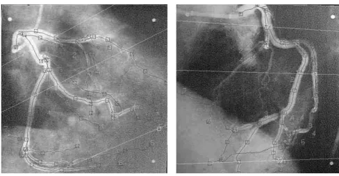 Figure 1Example of a pair of corresponding LAO and RAO projectionsExample of a pair of corresponding LAO and RAO projections