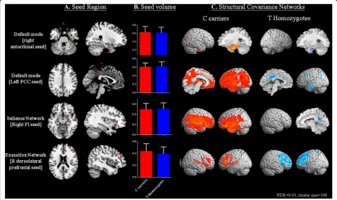 Fig. 1 Statistical maps depicting brain areas in which the gray matter intensity covaried with (a) four target seeds, (b) comparisons of seedvolumes, and (c) separate structural covariance network in patients with Alzheimer’s disease with interleukin-1 bet