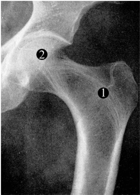 Figure 1The human hip jointThe human hip joint. Radiograph of the human proximal femur and acetabulum in which the two main systems of trabeculae (group 1 and 2) are indicated
