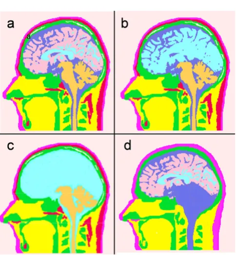 Figure 2the gray matter(Left) A-3D view of the head model superimposed with 145 EEG electrode positions, (right) a map of cortical voxel points in (Left) A-3D view of the head model superimposed with 145 EEG electrode positions, (right) a map of cortical voxel points in the gray matter.