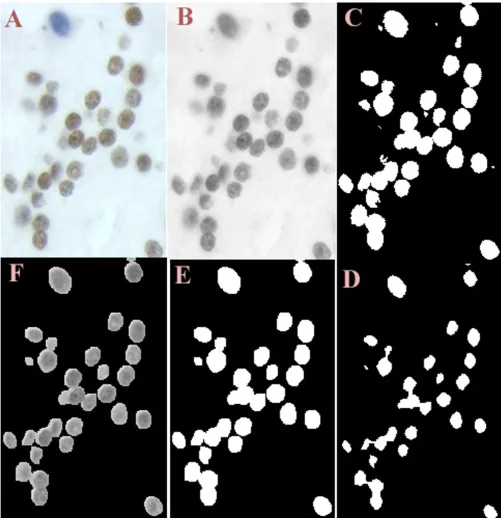 Figure 4(clockwise)(clockwise). A – Part of the original image, B – Intensity image, C – Image after addition of R, G and B segmented images, D – Image after erosion (twice), E – Image after dilation (twice), F – Nuclear mask with intensity information.