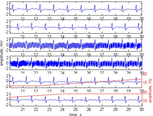 Figure 2Adaptive filtering applied on normal sinus rhythmAdaptive filtering applied on normal sinus rhythm