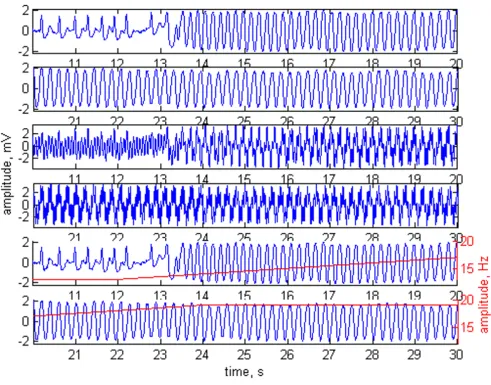 Figure 4Adaptive filtering applied on a patient with ventricular fibrillationbetween shown by red trace and red scale on the right
