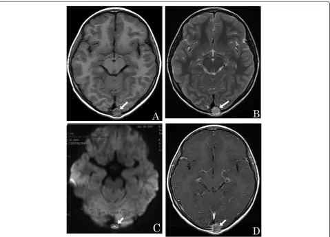Figure 1 A 7-year-old girl with an eosinophilic granuloma. (A) Axial T1-weighted image showing an isointense small round mass within theoccipital bone (arrow)