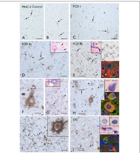 Figure 3 Distribution of MHC-I immunoreactivity (IR) in FCD, TSC and GG.insert (are negative (asterisks)