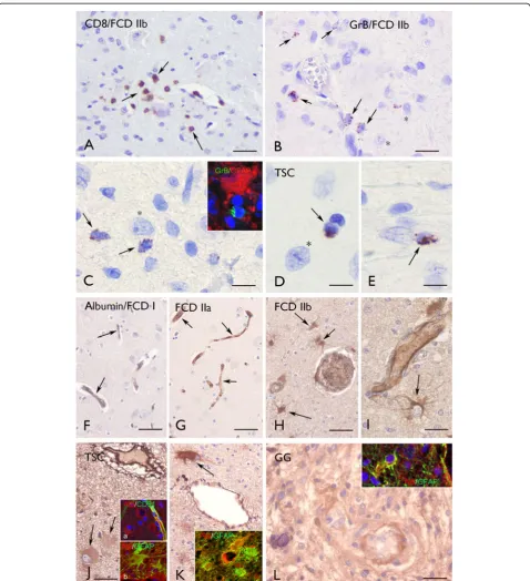 Figure 4 Granzyme B (GrB) and albumin immunoreactivity (IR).a dysmorphic neuron (asterisk in ((FCD IIb